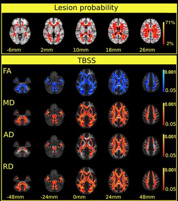 Gray Matter Atrophy Is Primarily Related to Demyelination of Lesions in Multiple Sclerosis: A Diffusion Tensor Imaging MRI Study